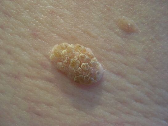 Papilloma