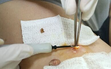 Chirurgische Behandlung des menschlichen Papillomvirus