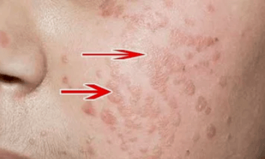 wie man das menschliche Papillomvirus erkennt