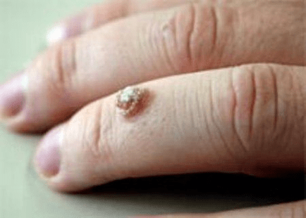 Warze am Finger