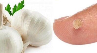 Behandlung von Warzen mit Volksheilmitteln