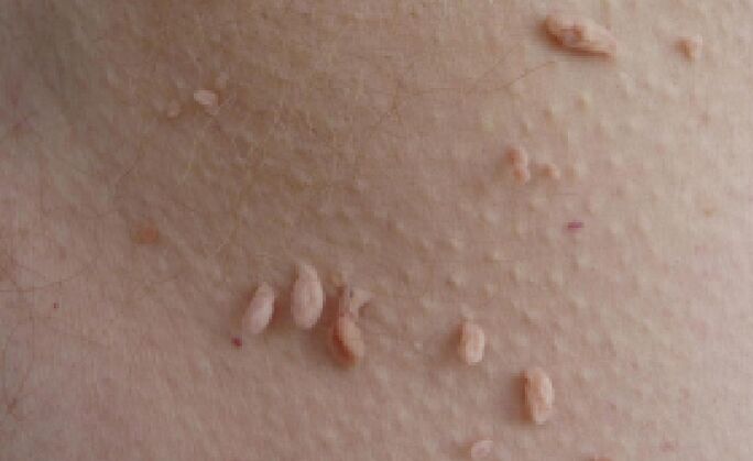 Gründe für das Auftreten von Papillomen am menschlichen Körper