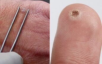 Symptome von Papillomen am menschlichen Körper