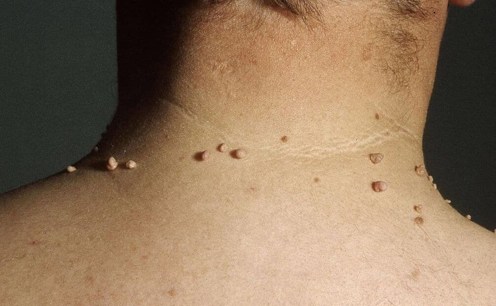 Ursachen für Papillome am Hals
